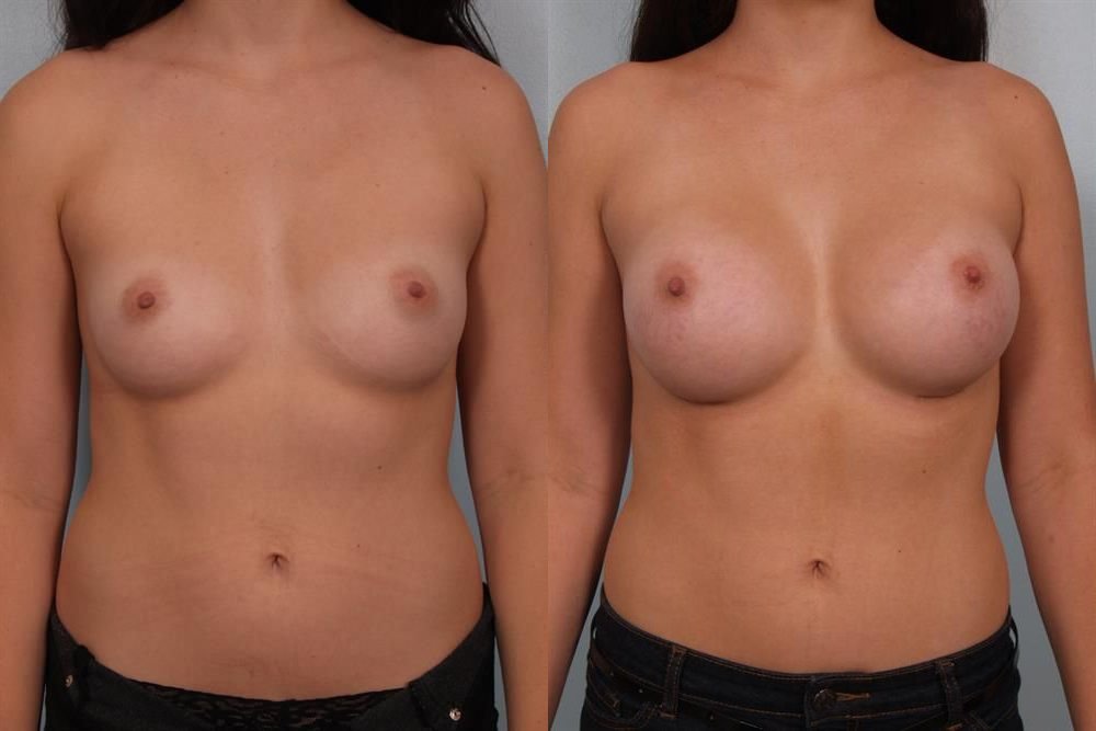 Breast Augmentation 77