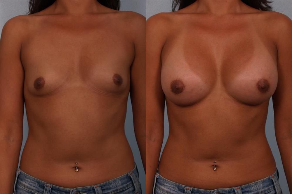 Breast Augmentation 78