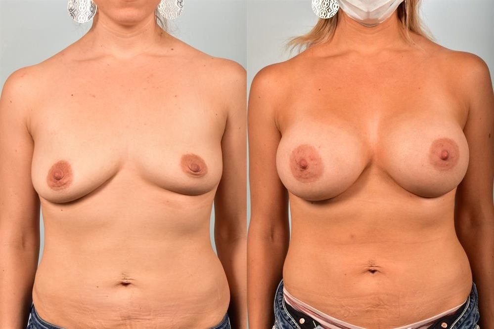 Breast Augmentation 79