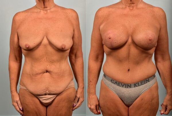 Breast Augmentation 8