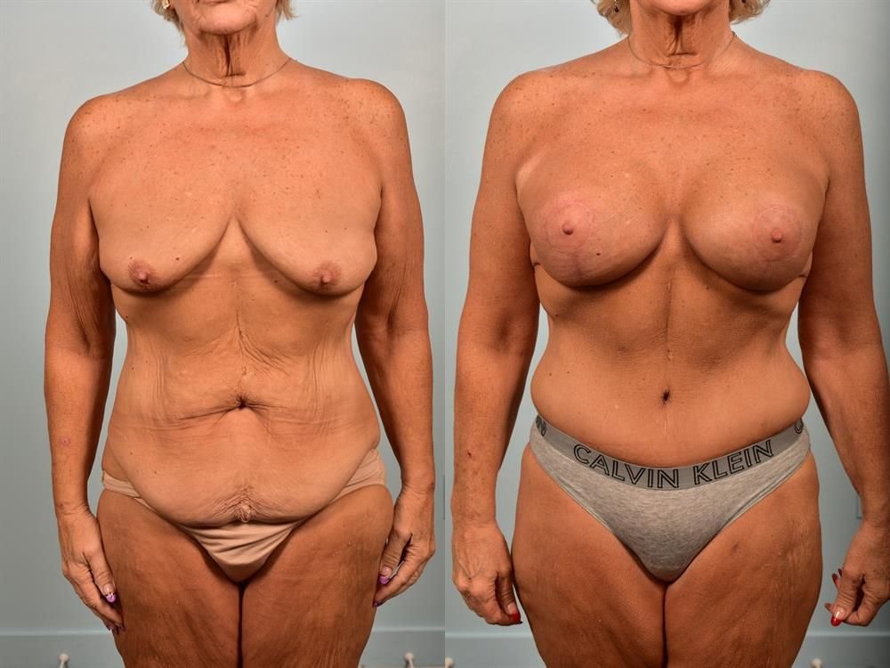 Breast Augmentation 8