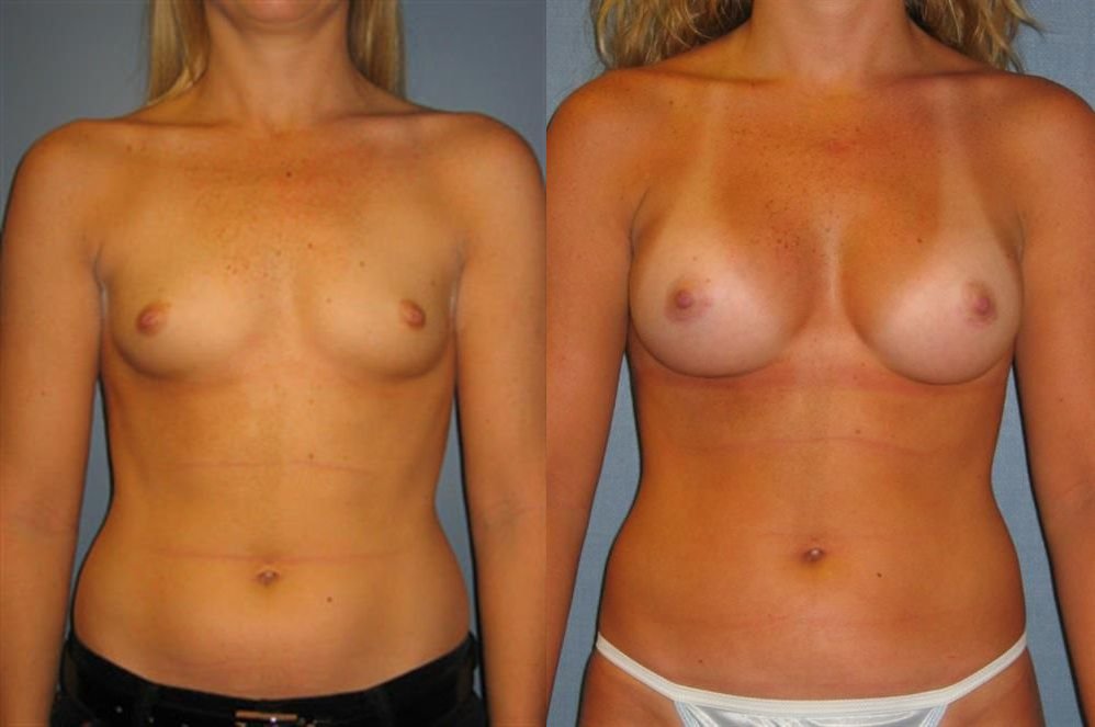 Breast Augmentation 81