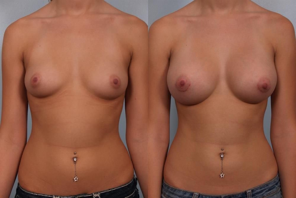 Breast Augmentation 82