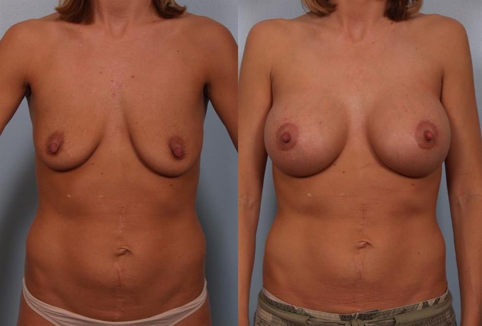 Breast Augmentation 83