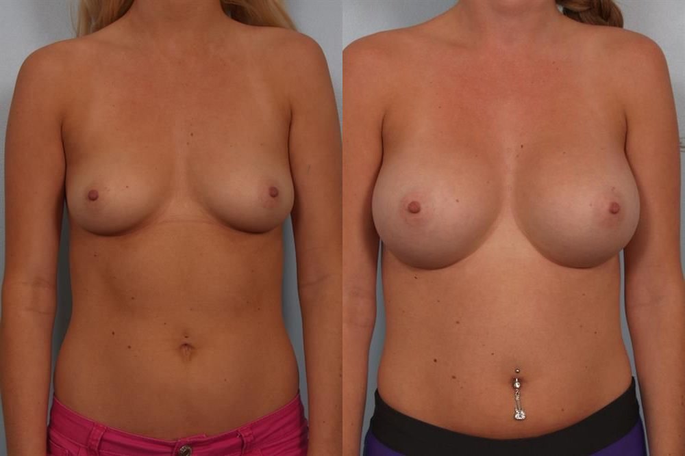 Breast Augmentation 85