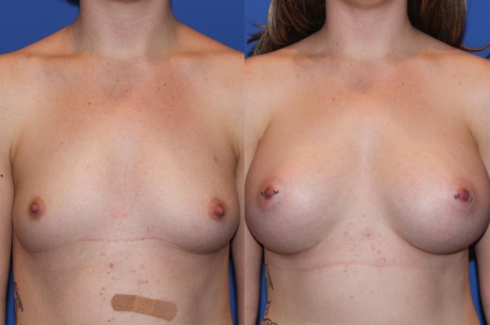 Breast Augmentation 86