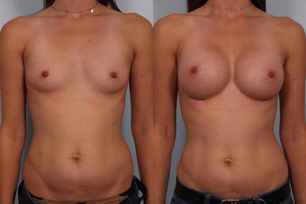 Breast Augmentation 87