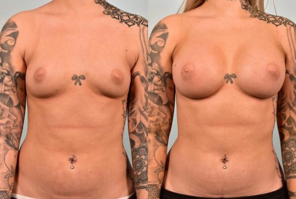 Breast Augmentation 88