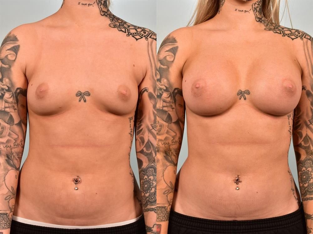 Breast Augmentation 88