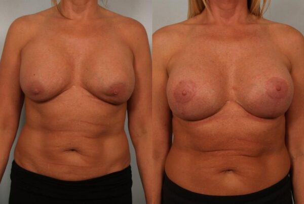 Breast Augmentation 89