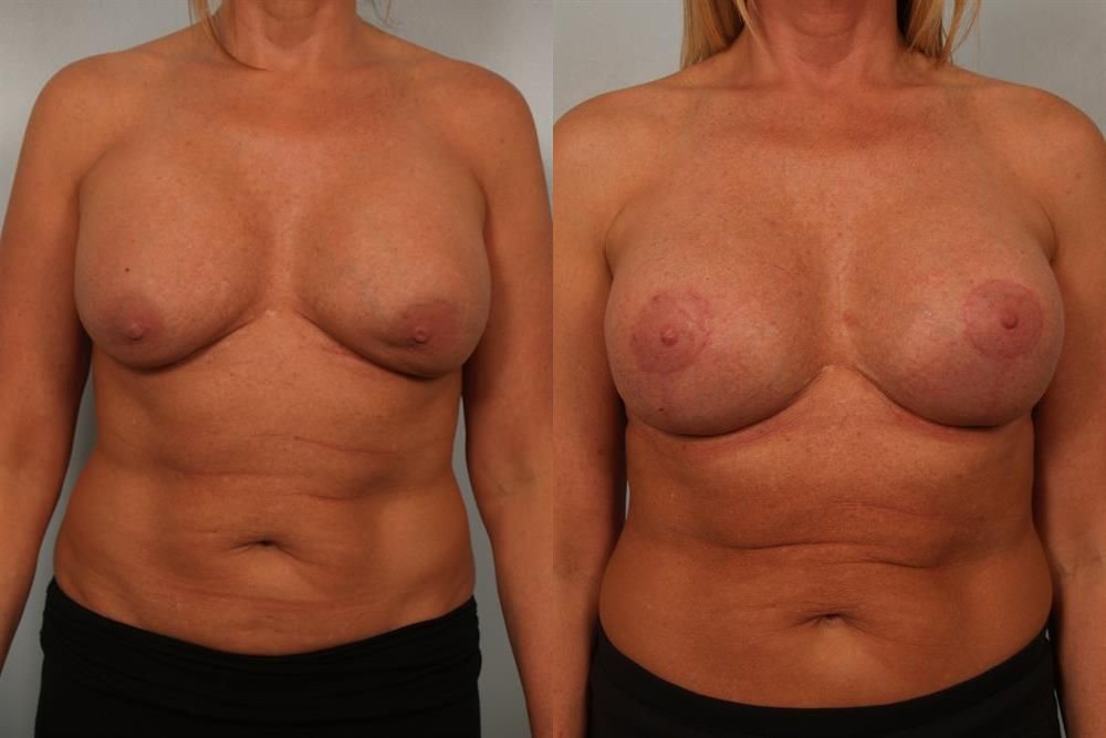 Breast Augmentation 89