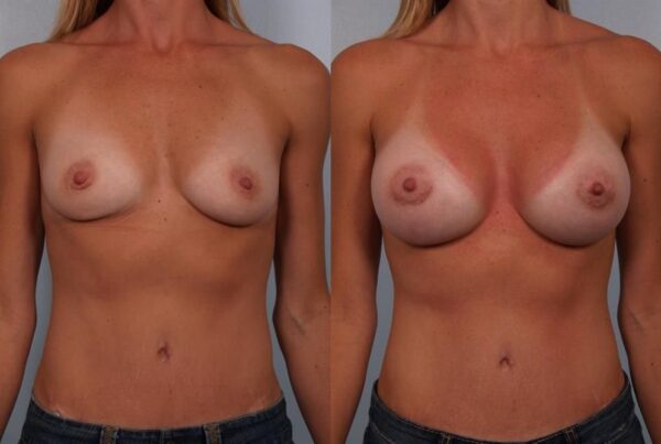 Breast Augmentation 90