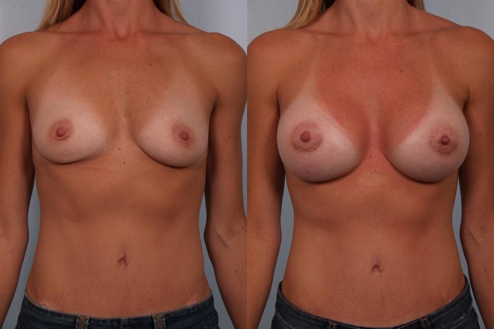Breast Augmentation 90
