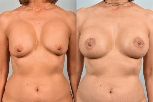 Breast Augmentation 91