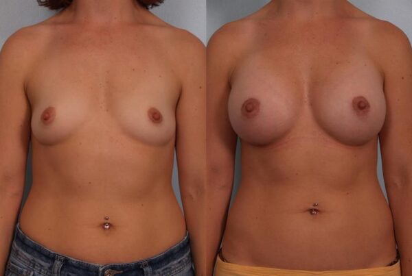 Breast Augmentation 92