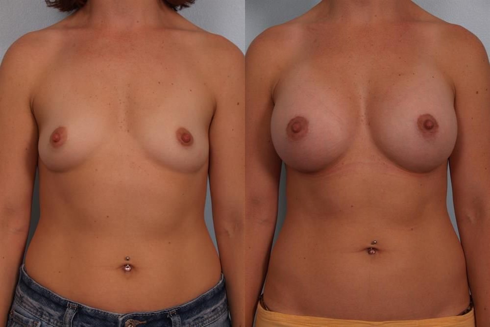 Breast Augmentation 92