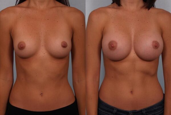 Breast Augmentation 93