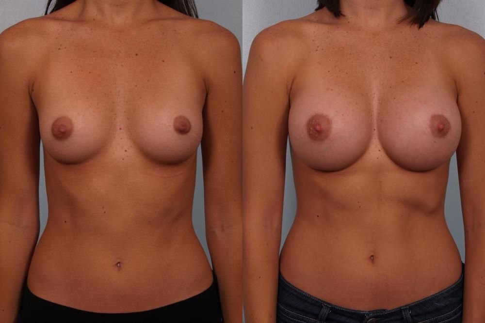 Breast Augmentation 93