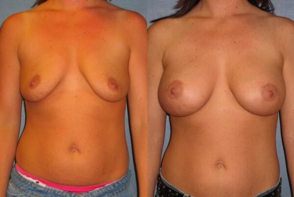 Breast Augmentation 94