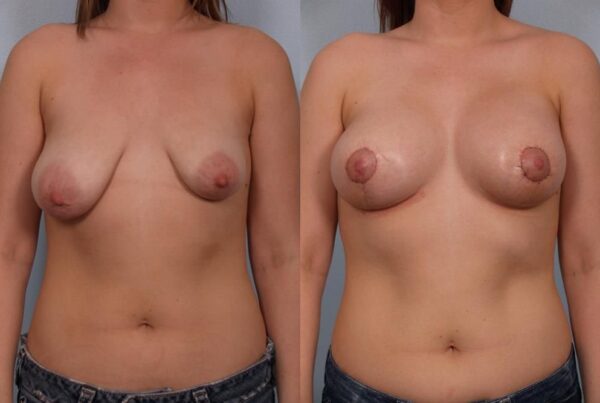 Breast Augmentation 95