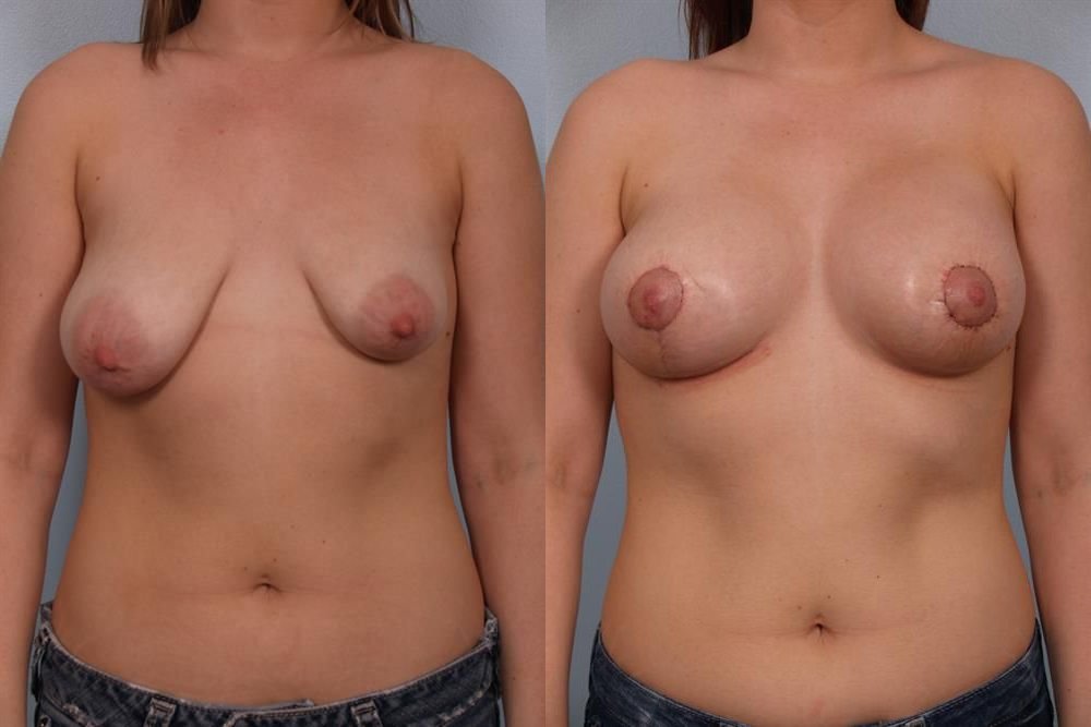Breast Augmentation 95