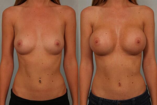 Breast Augmentation 96