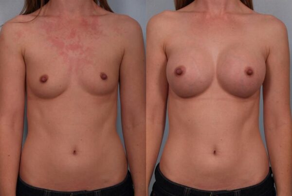 Breast Augmentation 97