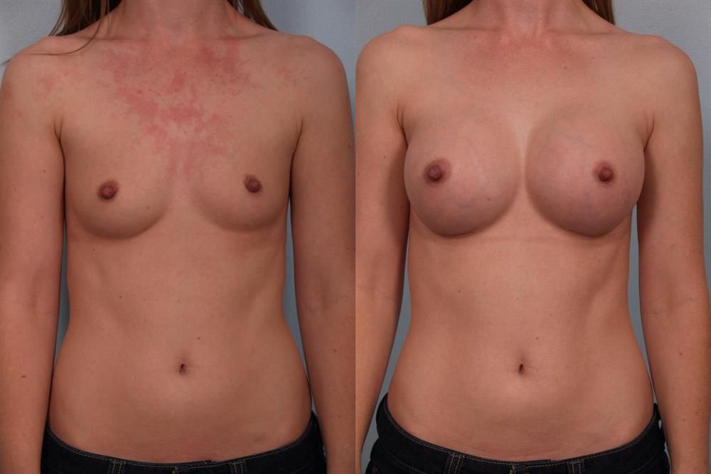 Breast Augmentation 97