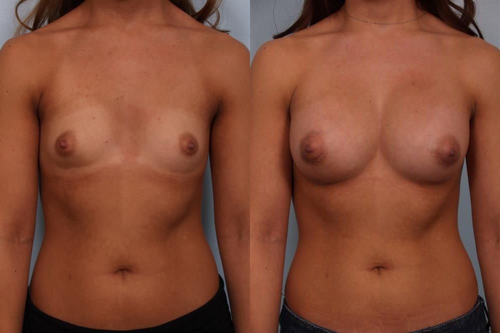 Breast Augmentation 98