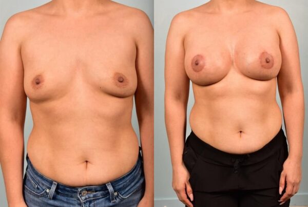 Breast Augmentation 99