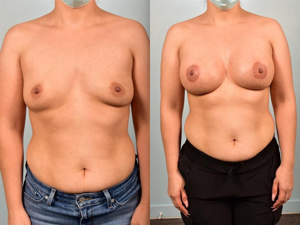 Breast Augmentation 99