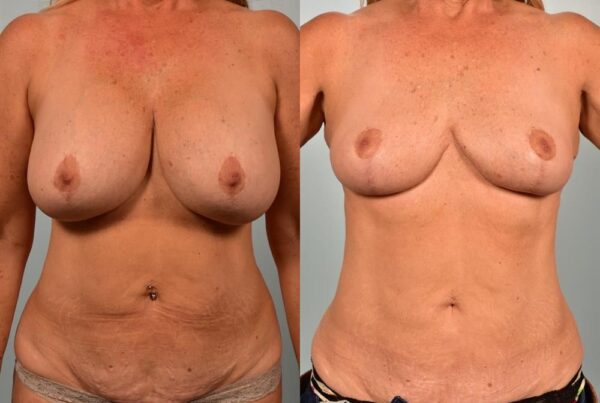 Breast Implant Removal 1