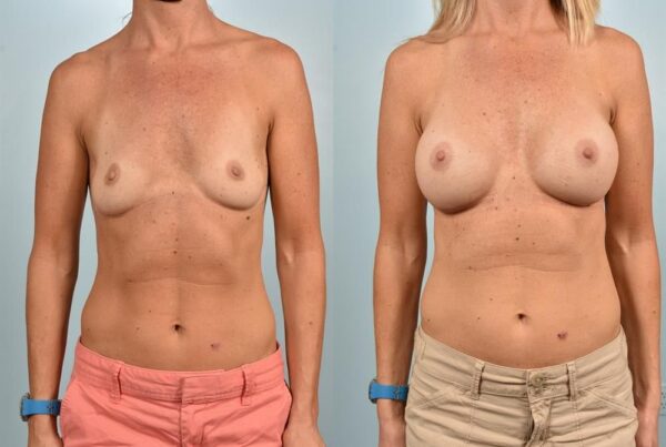 Breast Implant Removal 2