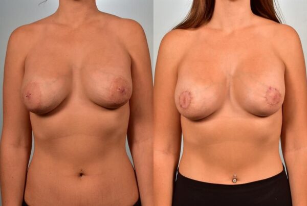 Breast Lift (Mastopexy) 1