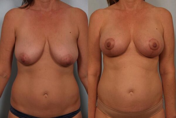 Breast Lift (Mastopexy) 10