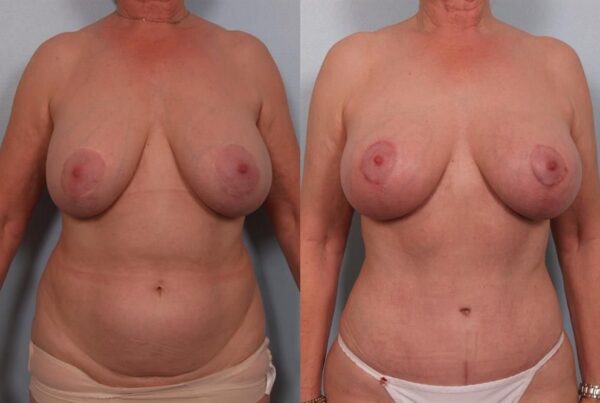 Breast Lift (Mastopexy) 100