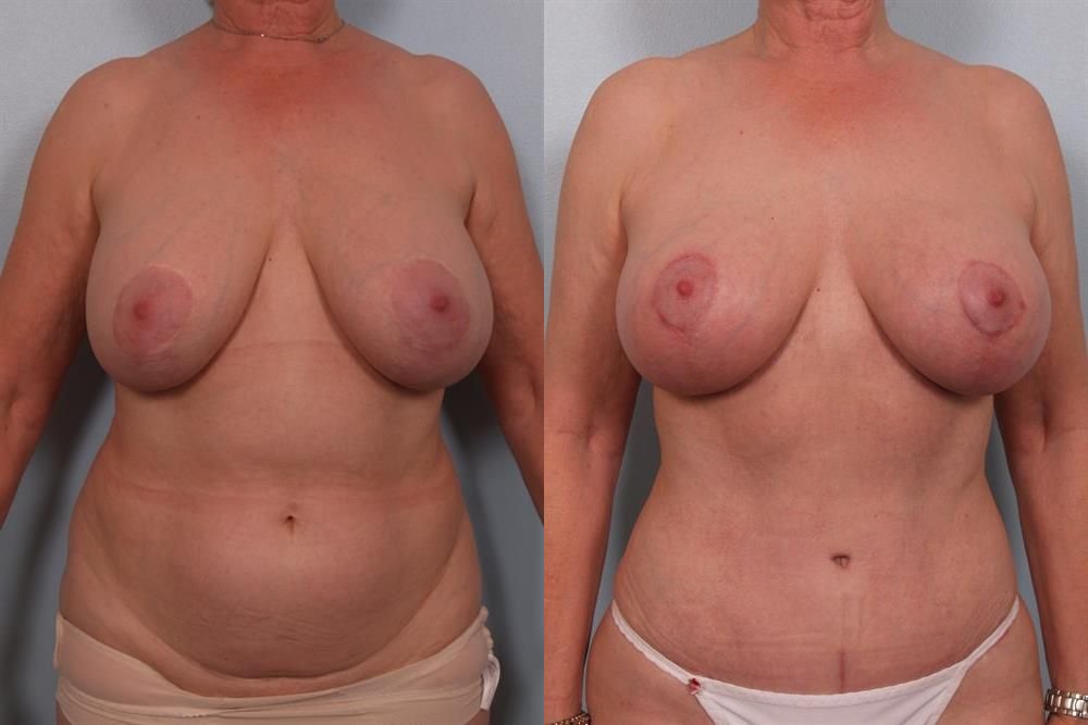 Breast Lift (Mastopexy) 100