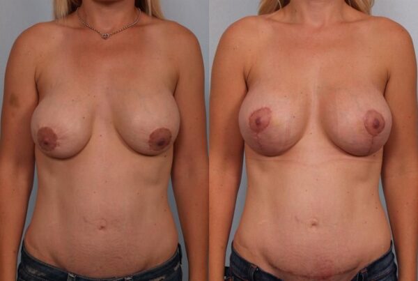 Breast Lift (Mastopexy) 101