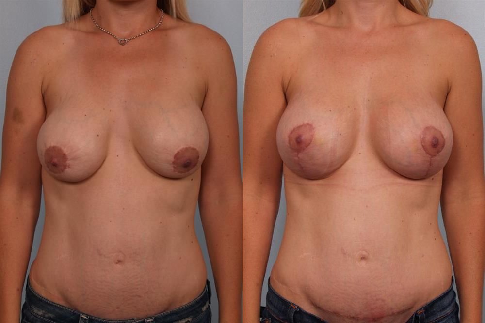 Breast Lift (Mastopexy) 101