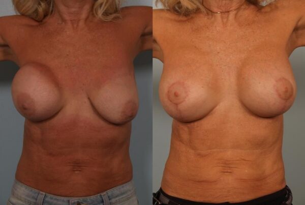 Breast Lift (Mastopexy) 102
