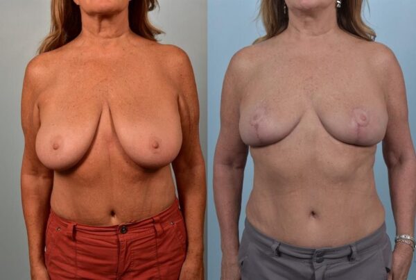 Breast Lift (Mastopexy) 12
