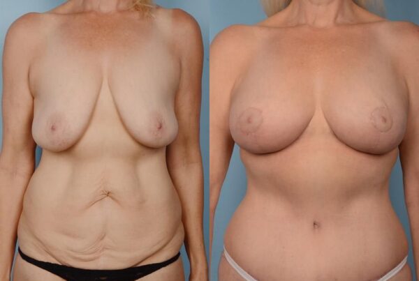 Breast Lift (Mastopexy) 13