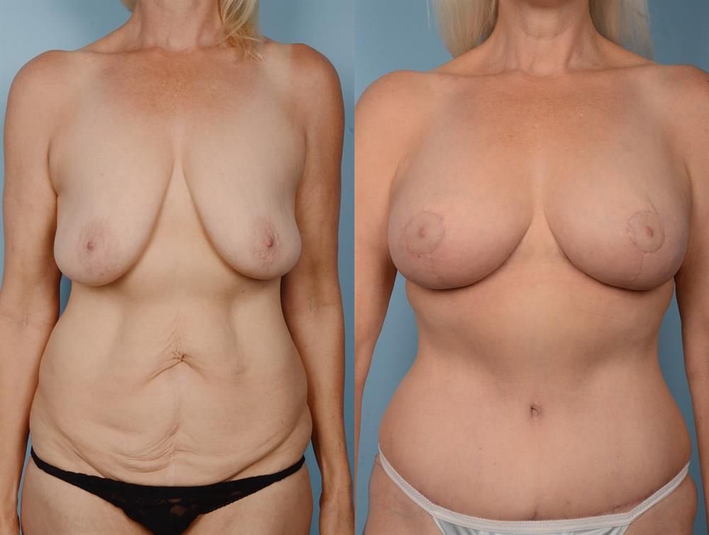 Breast Lift (Mastopexy) 13
