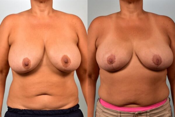 Breast Lift (Mastopexy) 14