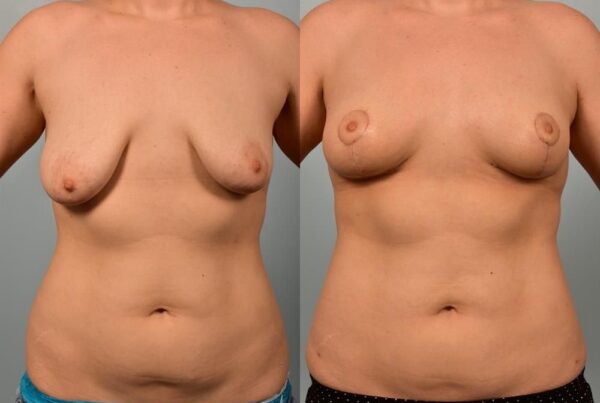 Breast Lift (Mastopexy) 15