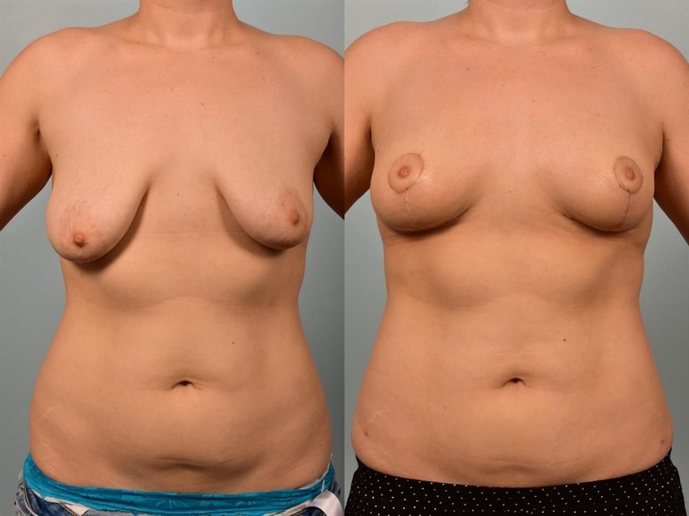 Breast Lift (Mastopexy) 15