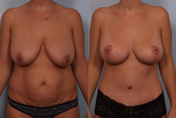 Breast Lift (Mastopexy) 16