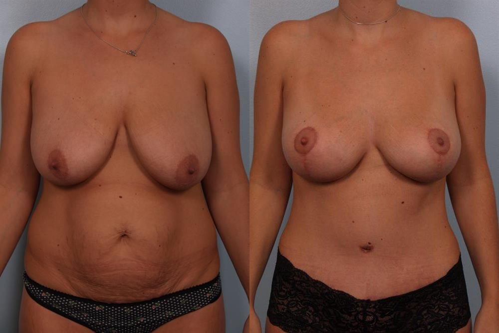 Breast Lift (Mastopexy) 16