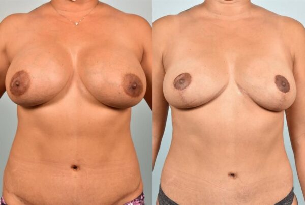Breast Lift (Mastopexy) 17
