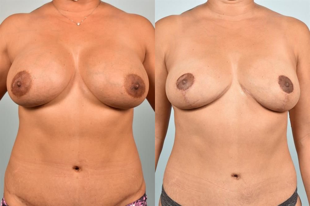 Breast Lift (Mastopexy) 17